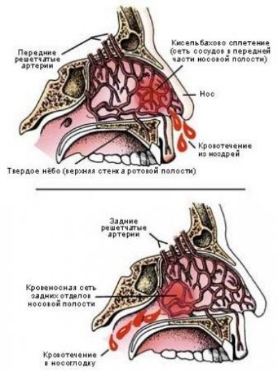 Носовые кровотечения